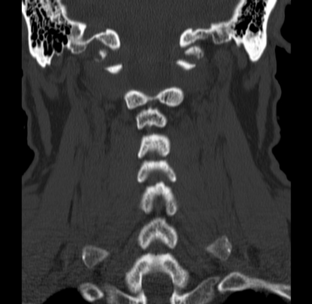 Anterior cervical postdiscectomy arthrodesis (Radiopaedia 32678-33646 Coronal bone window 45).jpg