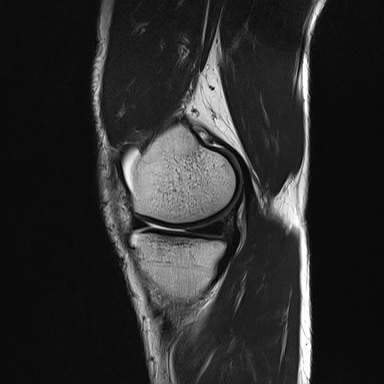 File:Anterior cruciate ligament full thickness tear (Radiopaedia 66268-75467 Sagittal T2 7).jpg