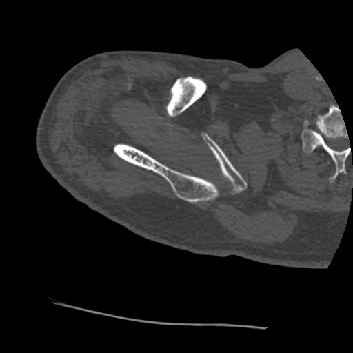 Anterior glenohumeral dislocation with Hill-Sachs lesion (Radiopaedia 62877-71249 Axial bone window 18).jpg