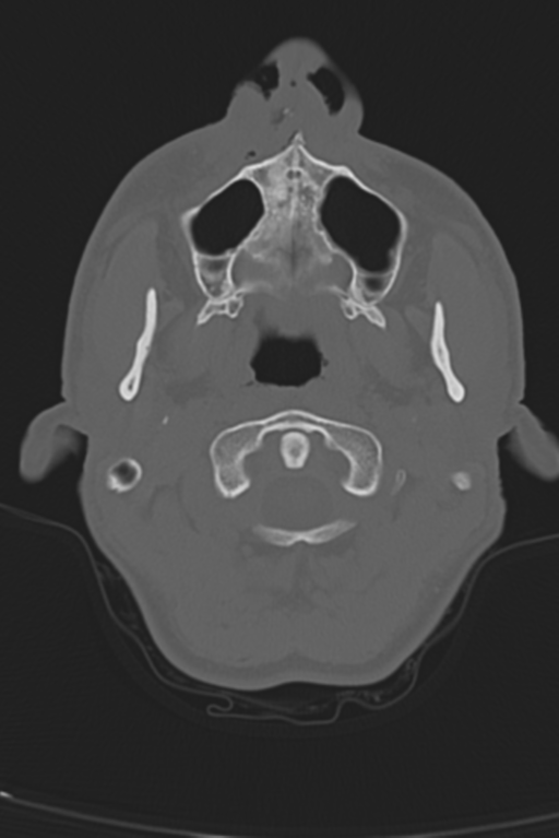 Anterior nasal spine fracture (Radiopaedia 46138-50494 Axial bone window 55).png