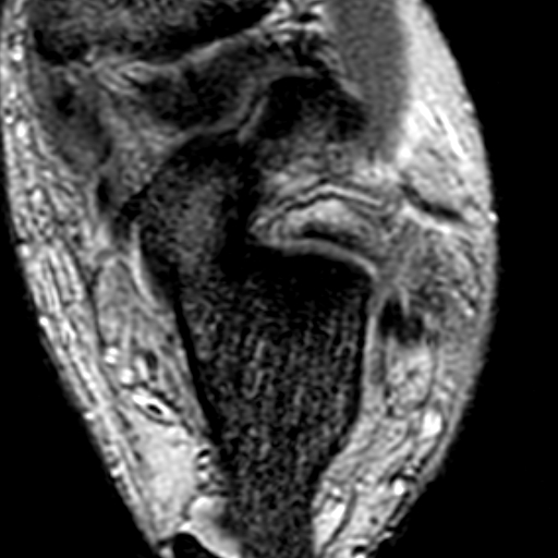 File:Anterior talofibular ligament rupture (Radiopaedia 15831-15484 Axial T2* 16).jpg