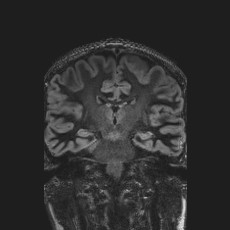 Anterior temporal encephalocele (Radiopaedia 82624-96808 Coronal FLAIR 29).jpg