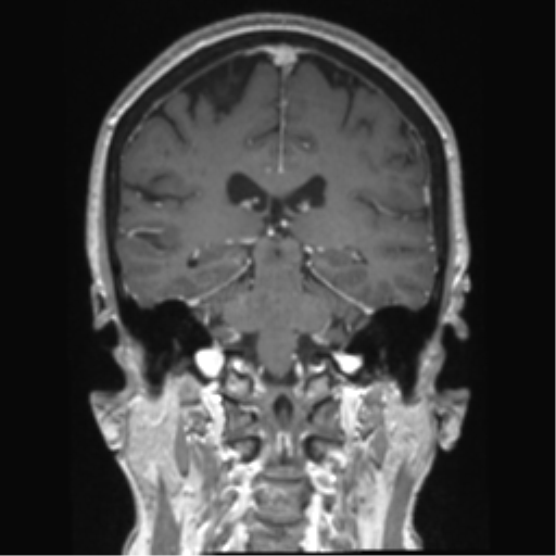 Anterior temporal pole cysts (Radiopaedia 46629-51102 Coronal T1 C+ 72).png