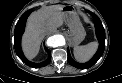 File:Anterior vertebral scalloping (abdominal aortic aneurysm) (Radiopaedia 66744-76067 F 1).jpg