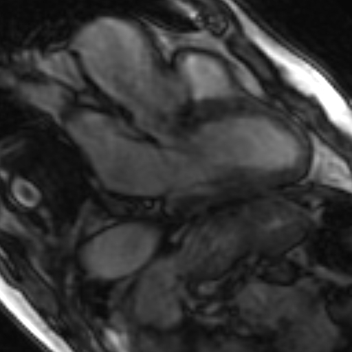 File:Anteroseptal hypokinesia after myocardial infarction (Radiopaedia 15978-15633 3 chamber view SSFE 9).jpg