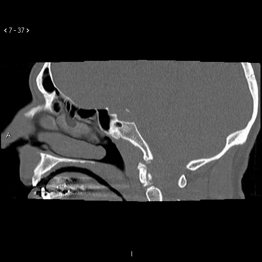 File:Antrochoanal Polyp (Radiopaedia 70510-80631 Sagittal bone window 27).jpg