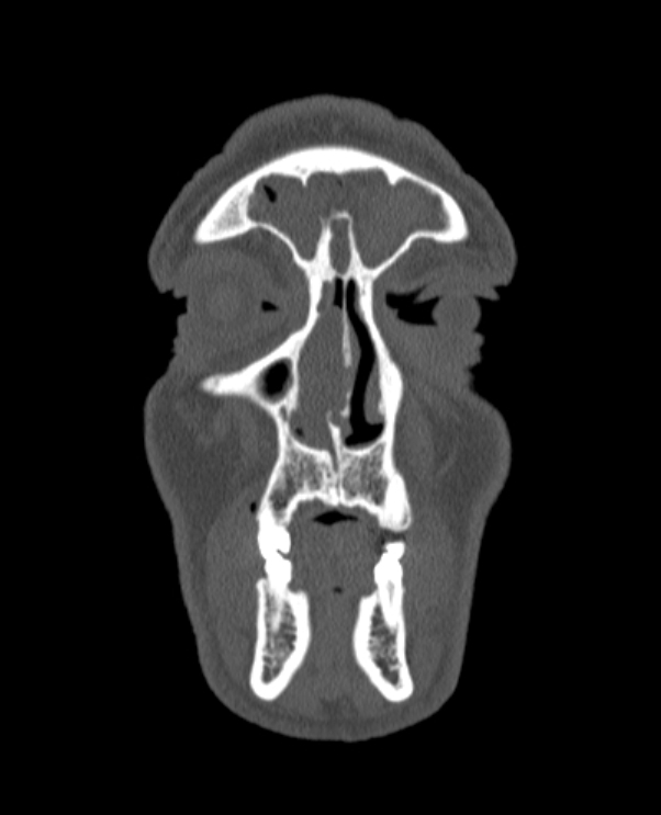 Antrochoanal polyp (Radiopaedia 79011-92169 Coronal bone window 75).jpg