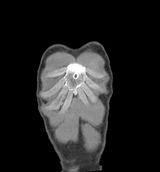 Aortic coarctation with aneurysm (Radiopaedia 74818-85828 C 8).jpg