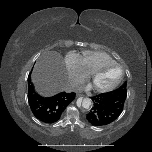 Aortic dissection- Stanford A (Radiopaedia 35729-37268 B 5).jpg