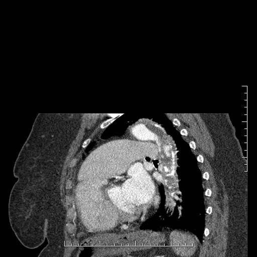 File:Aortic dissection- Stanford A (Radiopaedia 35729-37268 D 7).jpg