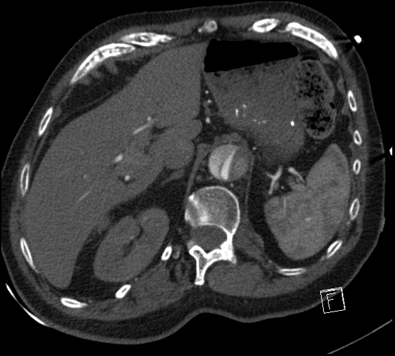 Aortic dissection (CTPA) (Radiopaedia 75506-86750 A 90).jpg