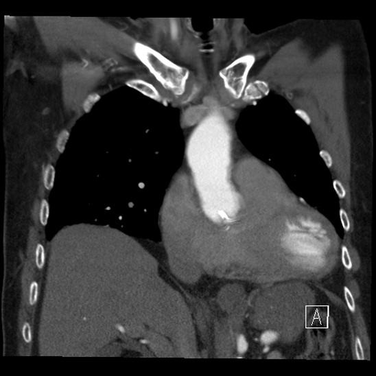 File:Aortic dissection (CTPA) (Radiopaedia 75506-86750 B 24).jpg