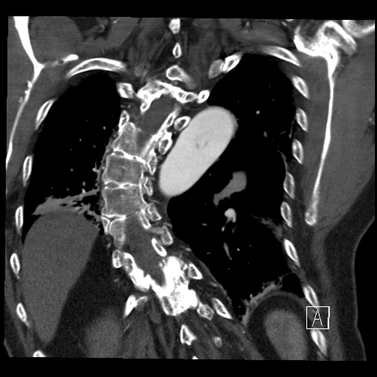 Aortic dissection (CTPA) (Radiopaedia 75506-86750 B 58).jpg