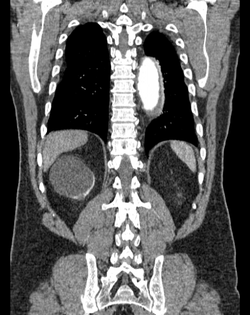 Aortic dissection (Radiopaedia 44411-48061 A 55).jpg