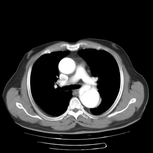 Aortic dissection (Radiopaedia 44411-48061 C 11).jpg
