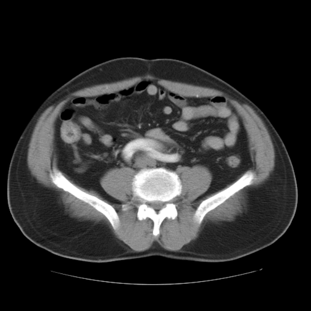 Aortic dissection (Radiopaedia 44411-48061 C 42).jpg