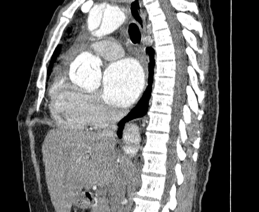 File:Aortic dissection - Stanford A -DeBakey I (Radiopaedia 28339-28587 C 24).jpg