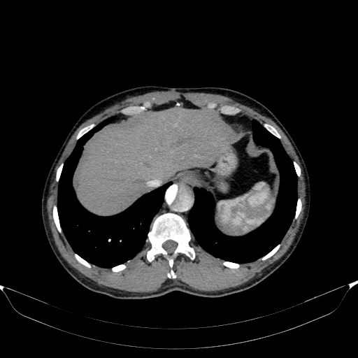 Aortic dissection - Stanford type A (Radiopaedia 83418-98500 A 55).jpg