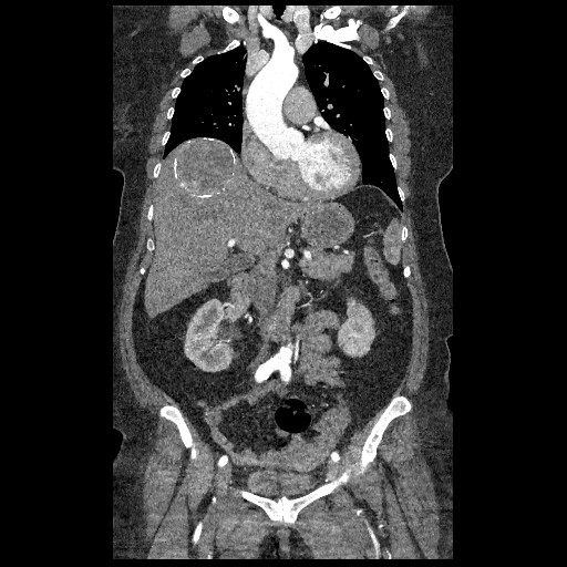 File:Aortic dissection - Stanford type B (Radiopaedia 88281-104910 B 25).jpg