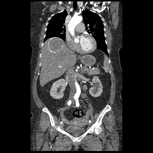 File:Aortic dissection - Stanford type B (Radiopaedia 88281-104910 B 30).jpg