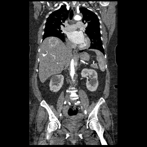 File:Aortic dissection - Stanford type B (Radiopaedia 88281-104910 B 39).jpg