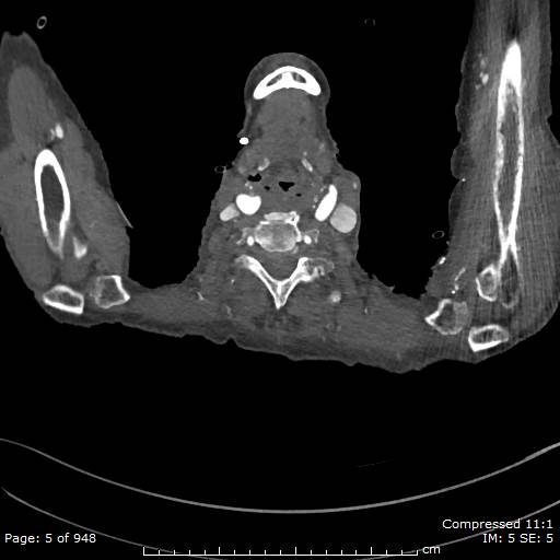 File:Aortic dissection with extension into aortic arch branches (Radiopaedia 64402-73204 B 5).jpg