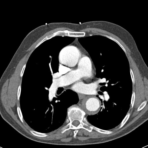 Aortic intramural hematoma (Radiopaedia 31139-31838 B 45).jpg
