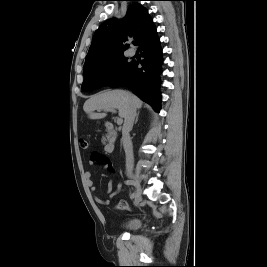 File:Aortic intramural hematoma (type B) (Radiopaedia 79323-92387 G 18).jpg