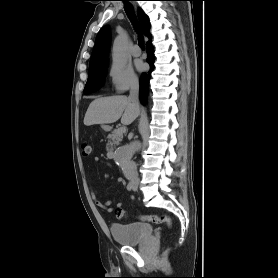 Aortic intramural hematoma (type B) (Radiopaedia 79323-92387 G 22).jpg