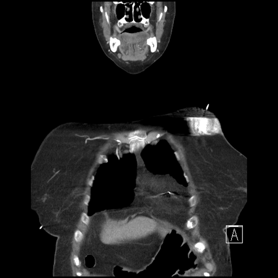 Aortic intramural hematoma with dissection and intramural blood pool (Radiopaedia 77373-89491 C 5).jpg