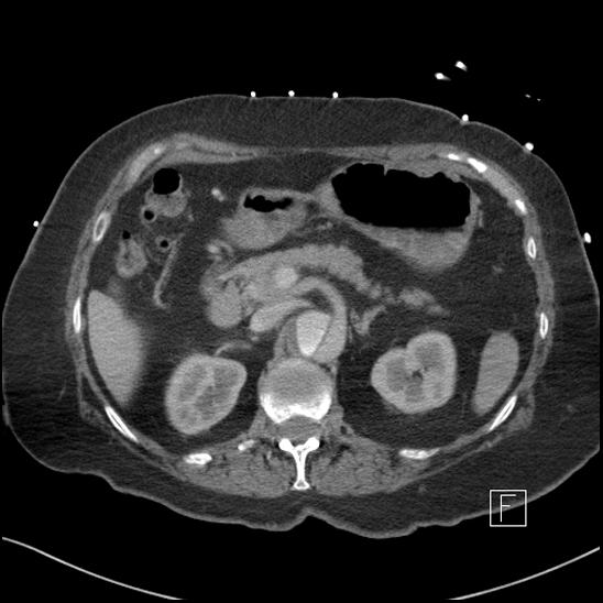 Aortic intramural hematoma with dissection and intramural blood pool (Radiopaedia 77373-89491 E 18).jpg