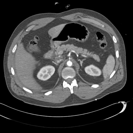 Aortic transection, diaphragmatic rupture and hemoperitoneum in a complex multitrauma patient (Radiopaedia 31701-32622 A 93).jpg
