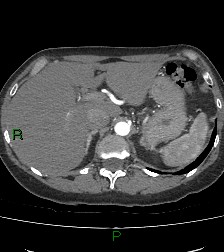 Aortic valve endocarditis (Radiopaedia 87209-103485 C 95).jpg
