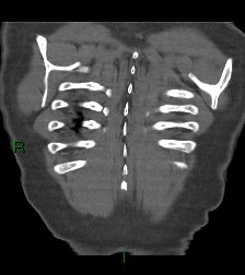 Aortic valve endocarditis (Radiopaedia 87209-103485 D 7).jpg