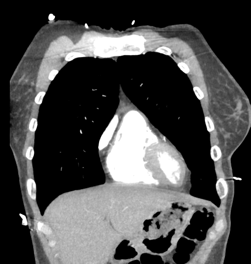 Aortic valve non-coronary cusp thrombus (Radiopaedia 55661-62189 C 20).png