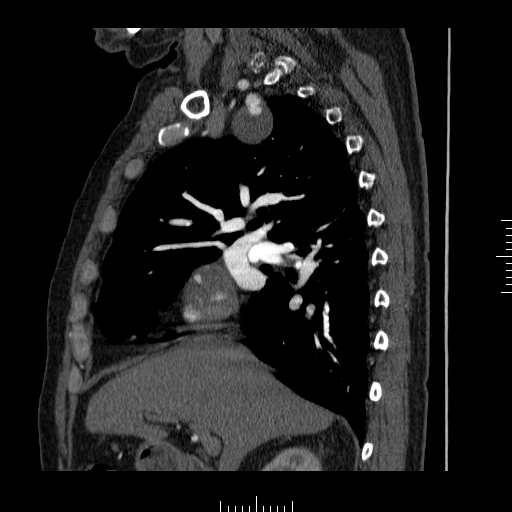 File:Aorto-coronary bypass graft aneurysms (Radiopaedia 40562-43157 C 8).png