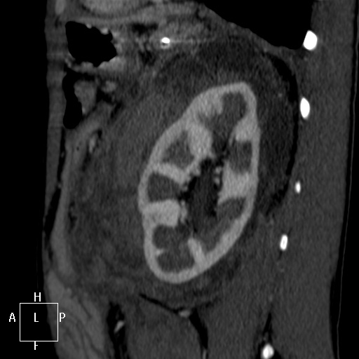 File:Aorto-left renal vein fistula (Radiopaedia 45534-49628 C 55).jpg