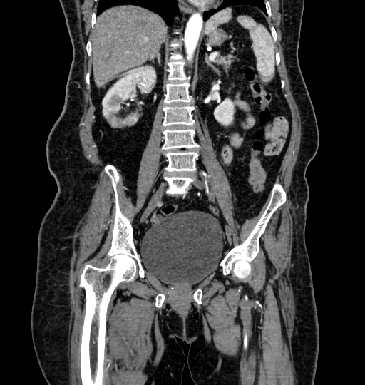 Aortoiliac occlusive disease (Radiopaedia 52352-58248 B 32).jpg