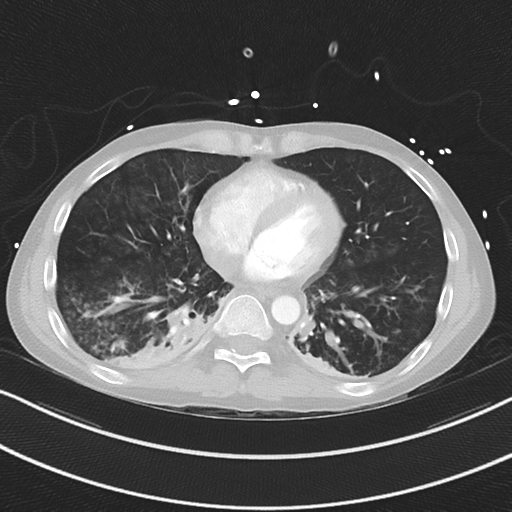 Apical bullous disease in a heavy smoker (Radiopaedia 33067-34092 Axial lung window 42).png
