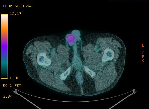 File:Appendiceal adenocarcinoma complicated by retroperitoneal abscess (Radiopaedia 58007-65041 Axial PET-CT 204).jpg