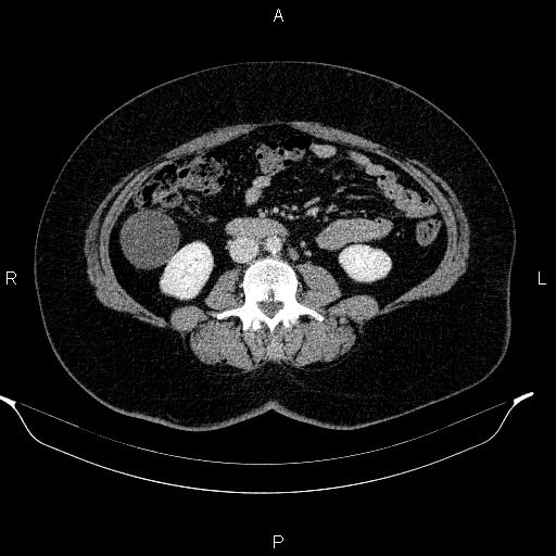 File:Appendiceal mucocele (Radiopaedia 83280-97688 Axial With contrast 57).jpg