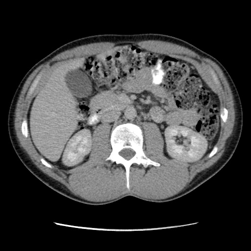 File:Appendicitis complicated by post-operative collection (Radiopaedia 35595-37113 A 29).jpg