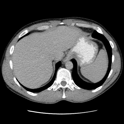 File:Appendicitis complicated by post-operative collection (Radiopaedia 35595-37113 A 9).jpg