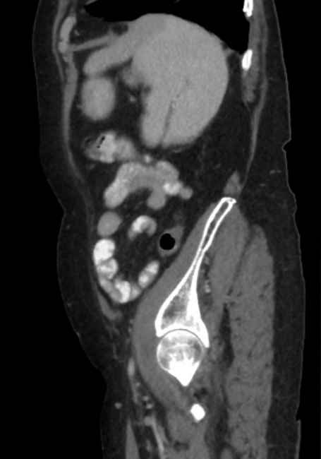 Appendicitis due to chicken fibula (Radiopaedia 74314-85198 C 82).jpg
