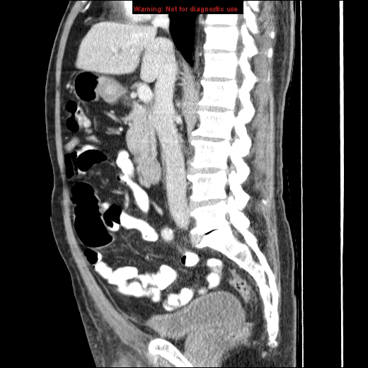 File:Appendicitis mass in inguinal hernia (Radiopaedia 26858-27029 C 25).jpg