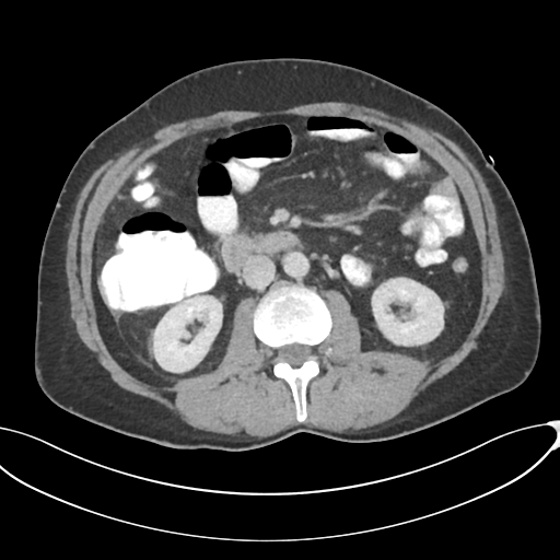 Appendicitis with thickening of the terminal ileum (Radiopaedia 42432-45550 A 45).png