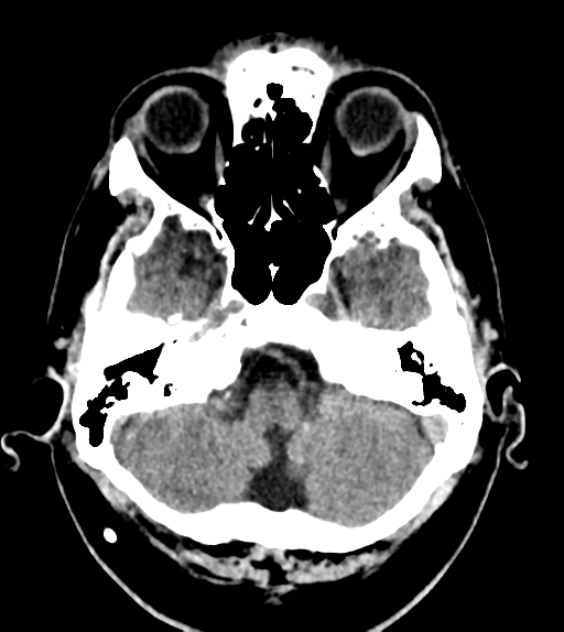 File:Aqueduct stenosis with corpus callosum hypoattenuation post shunting (Radiopaedia 37212-38971 Axial non-contrast 5).png