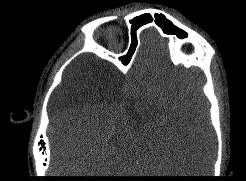 Arachnoid cyst- extremely large (Radiopaedia 68741-78450 Axial bone window 37).jpg