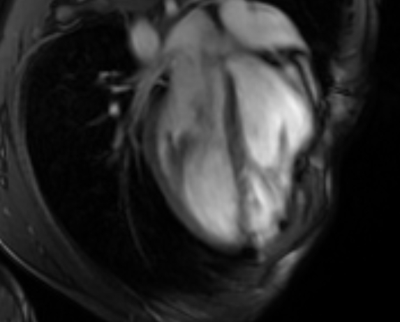 File:Arrhythmogenic right ventricular cardiomyopathy (Radiopaedia 69564-79464 4ch cine 52).jpg