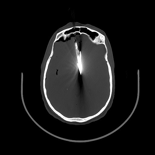 Arrow injury to the brain (Radiopaedia 72101-82607 Axial bone window 71).jpg